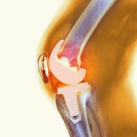 bone on bone knee pain relief