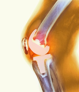 bone on bone knee pain relief