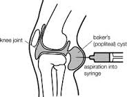 Draining a Baker's Cyst