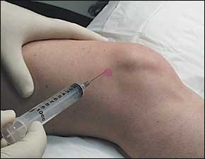knee injections