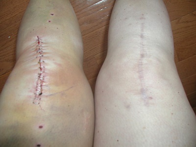 Pain after knee replacement surgery