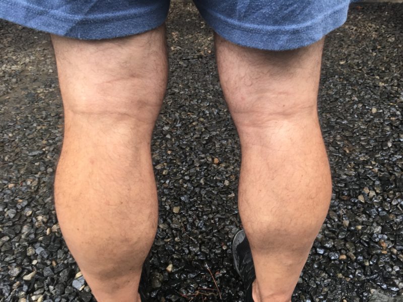 A Natural Strategy for Baker's Cysts The Knee Pain Guru